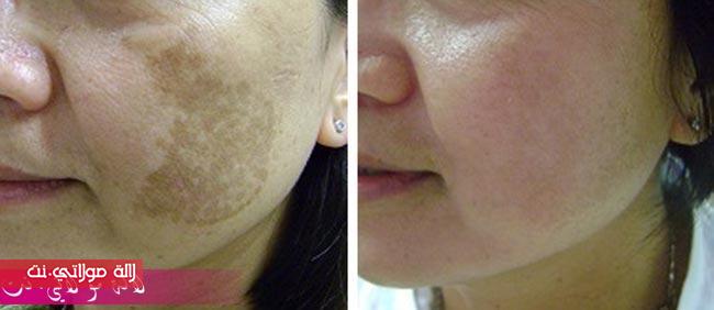 wasfa li 3laj laklaf