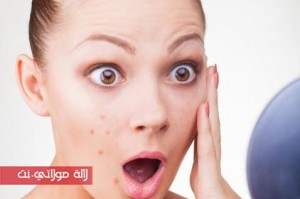 surprise-acne-causes-422x280