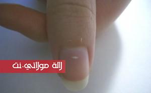 البقع البيضاء على الأظافر: 5وصفات طبيعية للتخلص منها 