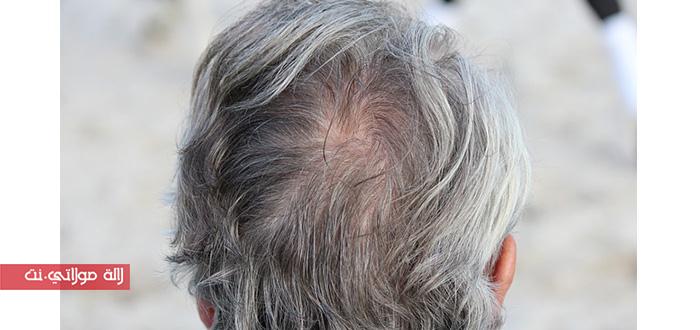 وصفة للتخلص من الشعر الأبيض