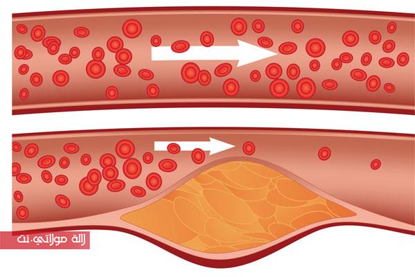 ارتفاع الكوليسترول