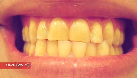 اصفرار الأسنان
