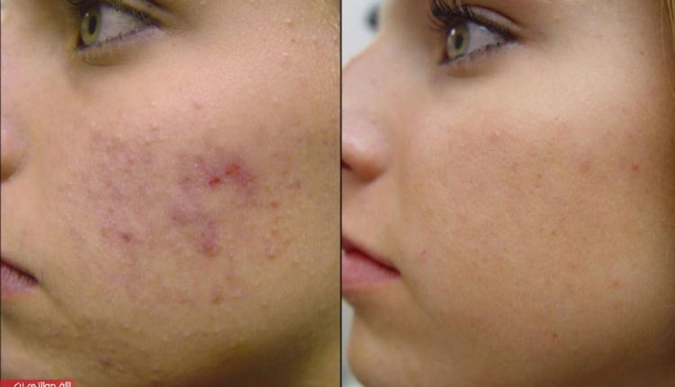 علاج اثار حب الشباب