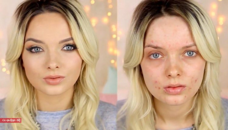 لن تصدقوا أن الثوم هو المعالج الأول لحب الشباب إليكم الطريقة