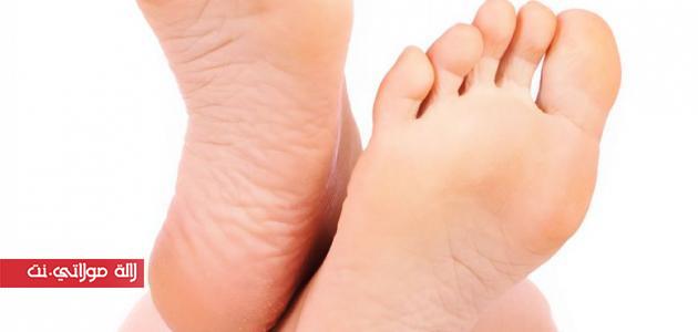 تشقق القدمين وكيفية معالجته