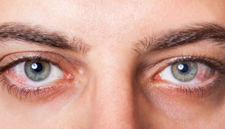 كيف تتجنبون الاصابة بجفاف العين؟