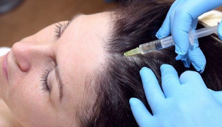 تقنية حقن بلازما الشعر وطريقة استخدامها