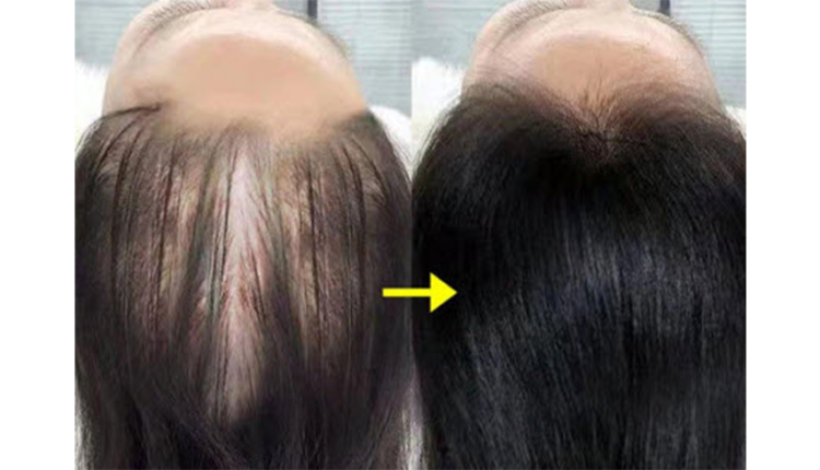 تساقط الشعر